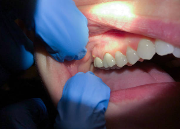 Best Emergency Dental Filling Replacement  in Jena, LA